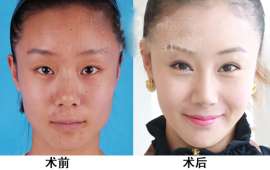 上海OPT美容仪器厂家OPT嫩肤OPT祛斑OPT快速脱毛